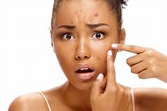 How To Get Rid Of Whiteheads