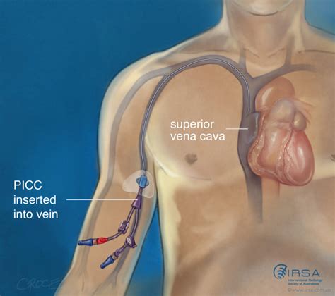 Peripherally Inserted Central Catheter (PICC) Insertion | IRSA