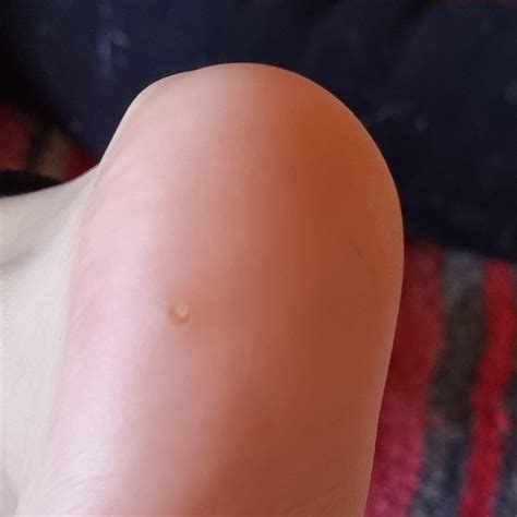 Wart, Corn or Verruca? : r/Warts