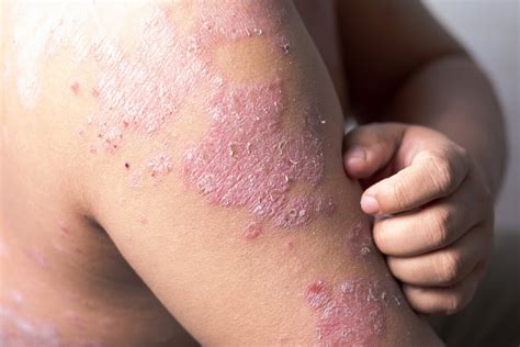 psoriasis symptoms   treatment  news
