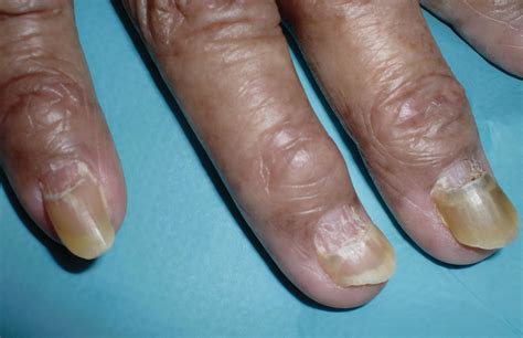 Abnormal Fingernails
