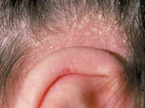 Seborrheic Dermatitis – DermAlive