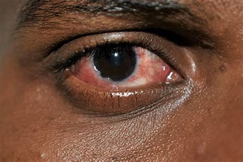 Apollo Eye Disease: Prevention, Symptoms and Treatment - Health Guide NG