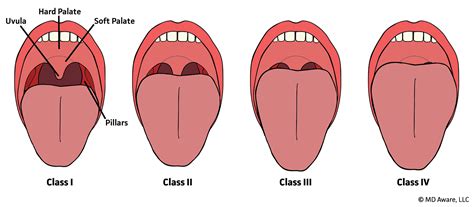 Modified Mallampati Classification