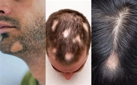 Очаговая алопеция - Cosmedica Clinic - Dr. Levent Acar