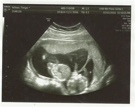 Did You Find Out It Was Twins At Later Ultrasound? Twin Ultrasound ...