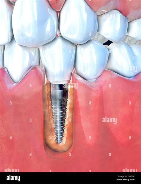 Dental implant, illustration Stock Photo - Alamy