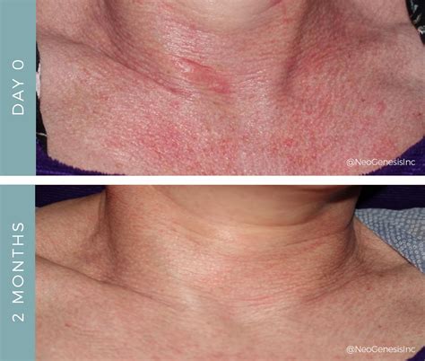 Rosacea On Neck - vrogue.co