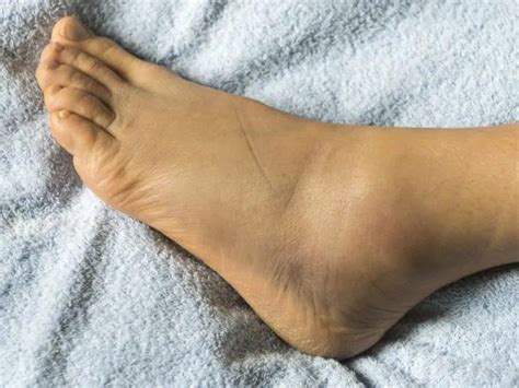 Tobillo Inflamado: Causas, Síntomas Y Tratamiento | Doctor Online