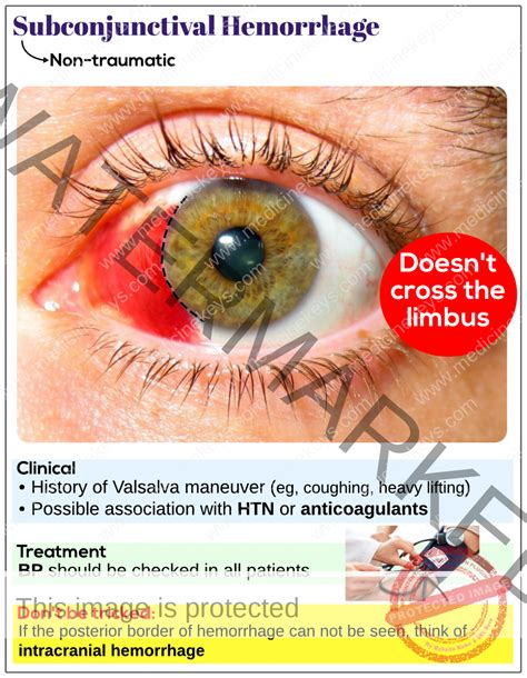 nursing diagnosis  subconjunctival hemorrhage qsjyvg
