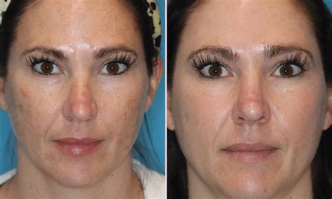 Moxi & BBL Stack | BBL Moxi Treatment - Eden Medical Clinic