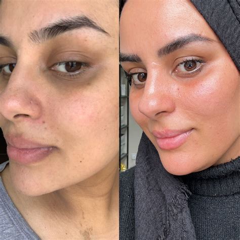 how to fix hyperpigmentation