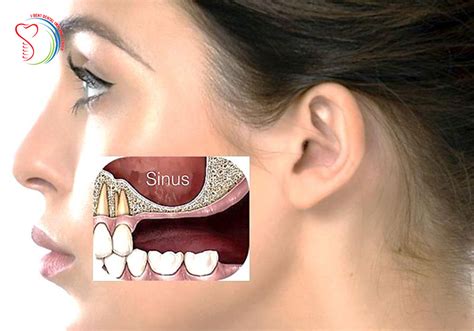 Maxillary Sinus Lift
