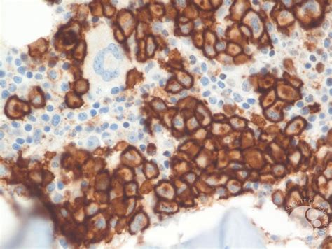 myeloma cd stain