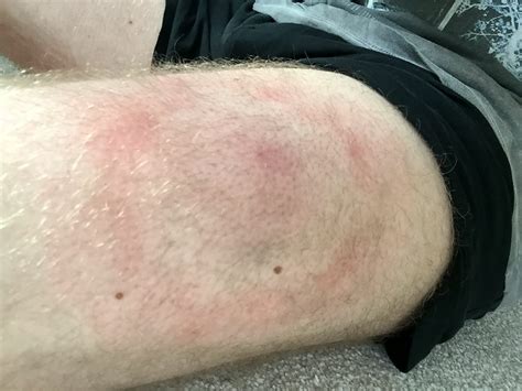 Man baffled after he developed a painful rash caused by an allergy - to