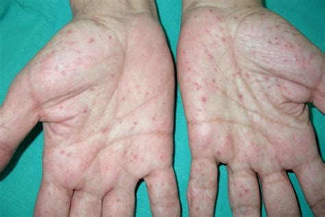 gorlin syndrome actas dermo sifiliograficas