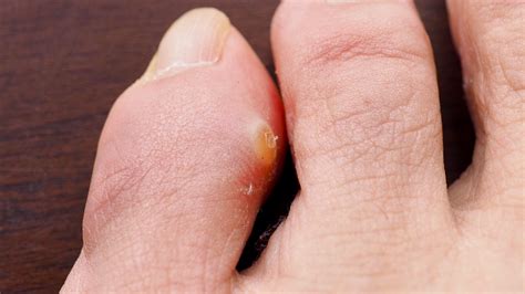 corn risk factors diagnosis  treatment healthy rounds