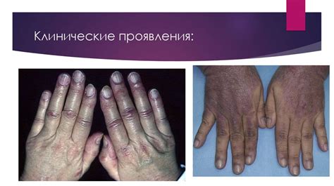 Дерматомиозит - презентация онлайн