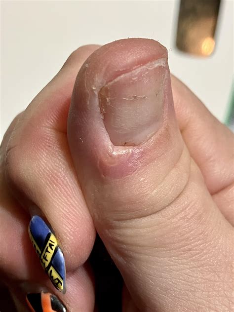 Do not do what I do here. Popping a myxoid cyst in the back country