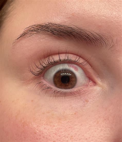 Eye redness 1 week post LASIK eye surgery : r/mildlyinteresting