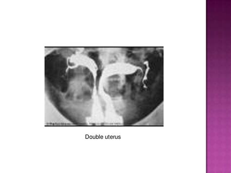 Hysterosalpingography