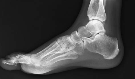 foot-xray - RCEMLearning