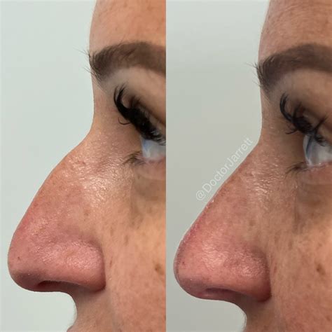 Nonsurgical Rhinoplasty - Designer Aesthetics by Dr. Jarrett Schanzer