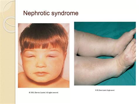 2 GLOMERULAR DISEASES.pptx