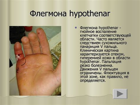 Флегмоны кисти - презентация онлайн