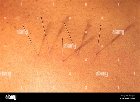 acupuncture needles   treatment traditional chinese