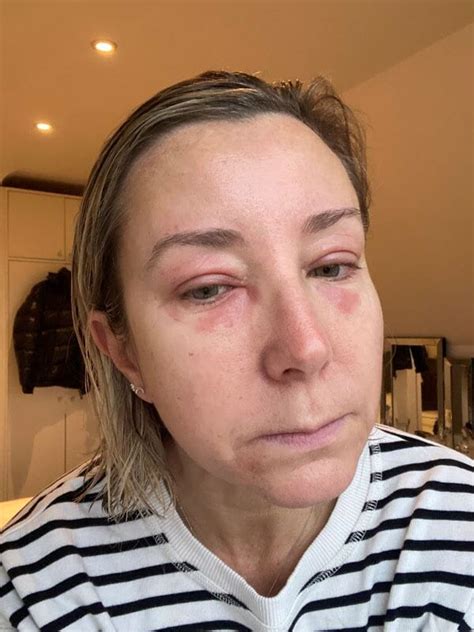 Eye Cream For Eyelid Eczema at Elizabeth Wells blog