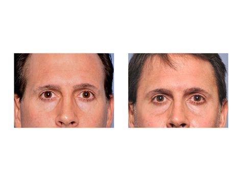 Implants for Temporal Augmentation - Explore Plastic Surgery