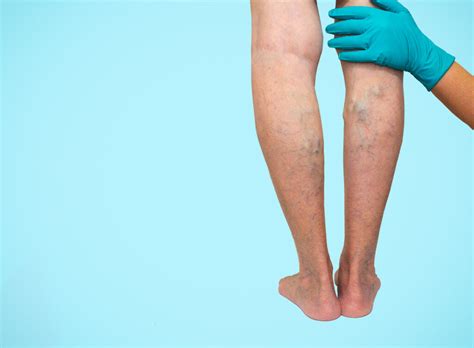 Варикозни Вени - Клиничка слика и Третман - GastroMed