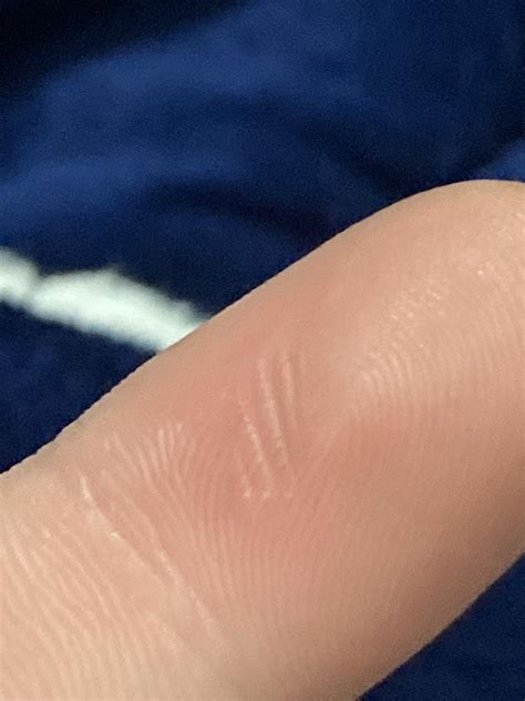 Burnt my index finger and thumb after touching a dermal bit immediately