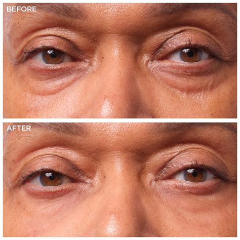 Under Eye Bags: A Plastic Surgeon Weighs In | IT Cosmetics