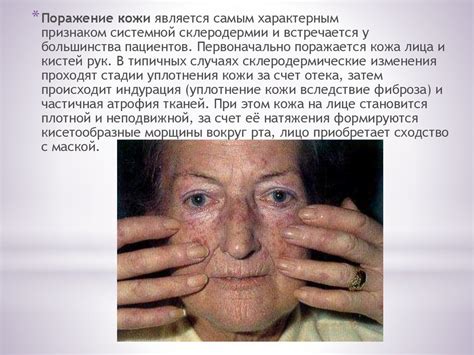 Системная склеродермия - online presentation