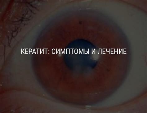 Кератит глаза: что это такое, симптомы и лечение