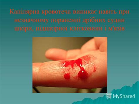 Презентация на тему: "Тема: тимчасова зупинка кровотечі при пораненнях ...