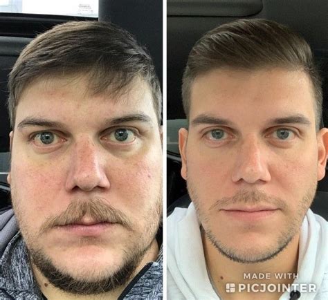 Antes E Depois Do Álcool - Uso De Alcool Antes E Depois