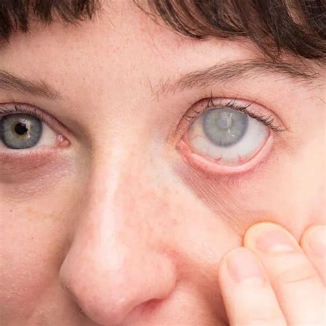 Glaucoma Treatment | Glaucoma Ophthalmologist