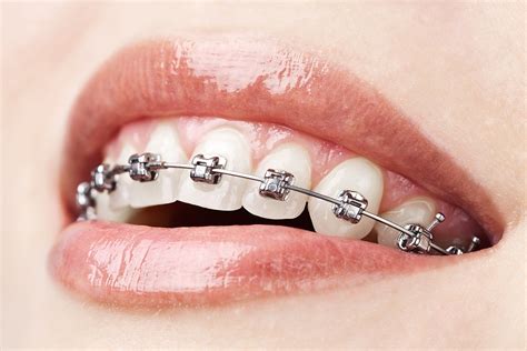 Braces in Brooklyn, NY | Hanson Place Orthodontics