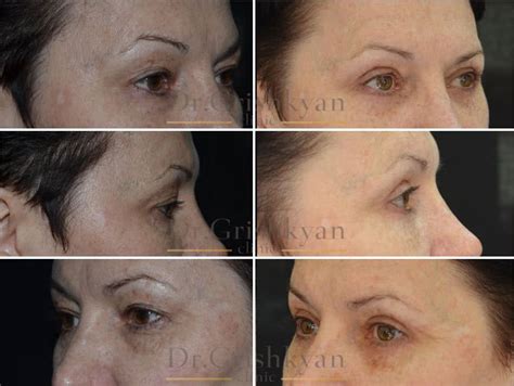 Блефаропластика. Фото до и после. | Cosmetic clinic, Nose ring, Cosmetics