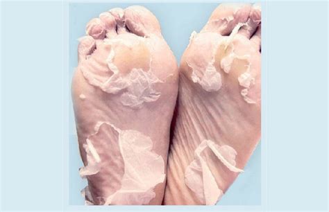 Trench Foot - Dangers Behind Wet Feet