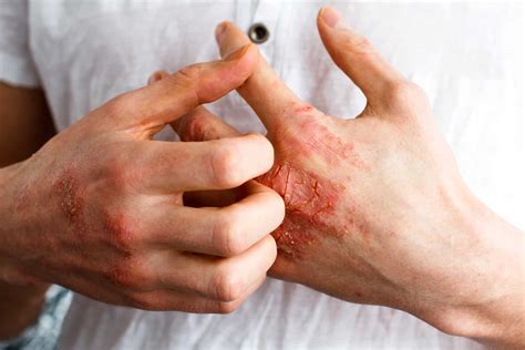 Mayo Clinic Q&A: Got itchy, red skin? - Mayo Clinic Press
