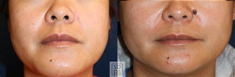 Dermatofibroma Removal Before After