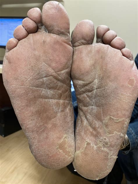 Onychomadesis and palmoplantar keratoderma associated with talquetamab