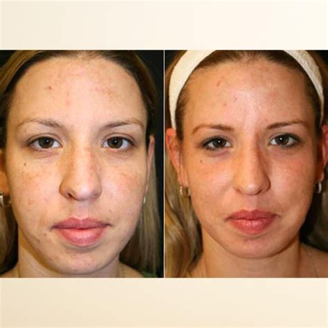 Say Goodbye to Pigmentation: Effective Laser Treatment in Singapore