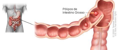 O Que Polipos No Estomago - Polipo Intestinal - Tipos de Polipos, Sintomas e Tratamento