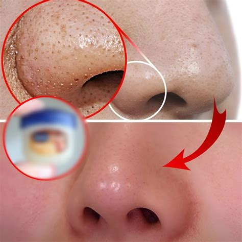 Is This Unbelievable Blackhead Removal 2024 Method REALLY Safe? Experts Weigh In. Image 11