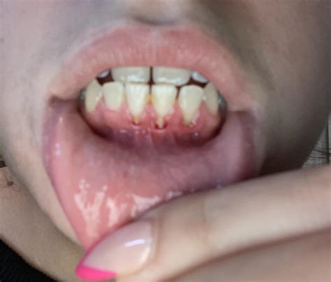 Gum problems, need advice urgently :( : r/DentalHygiene
